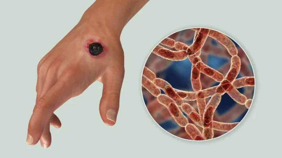 tratamiento-con-antibioticos-contra-antrax-es-sencillo_1-focus-0-0-896-504